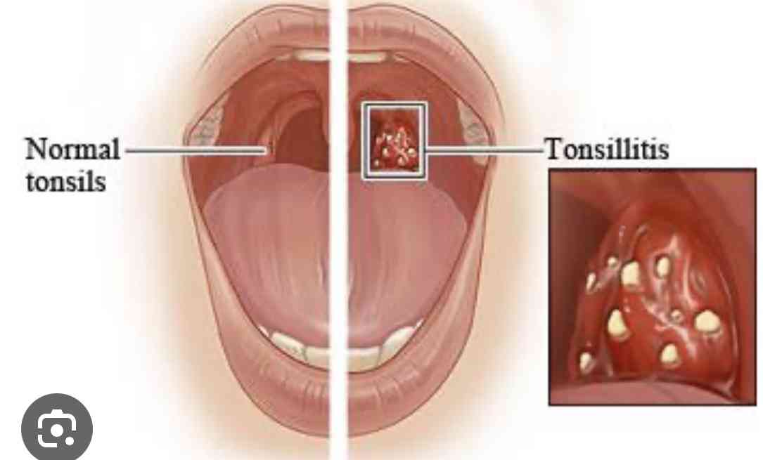 Symptoms Of Tonsillitis