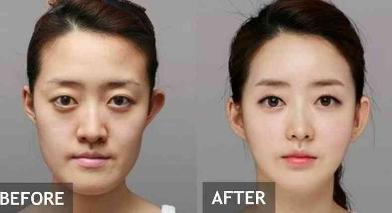 Koreans before and after plastic surgery - MirrorLog