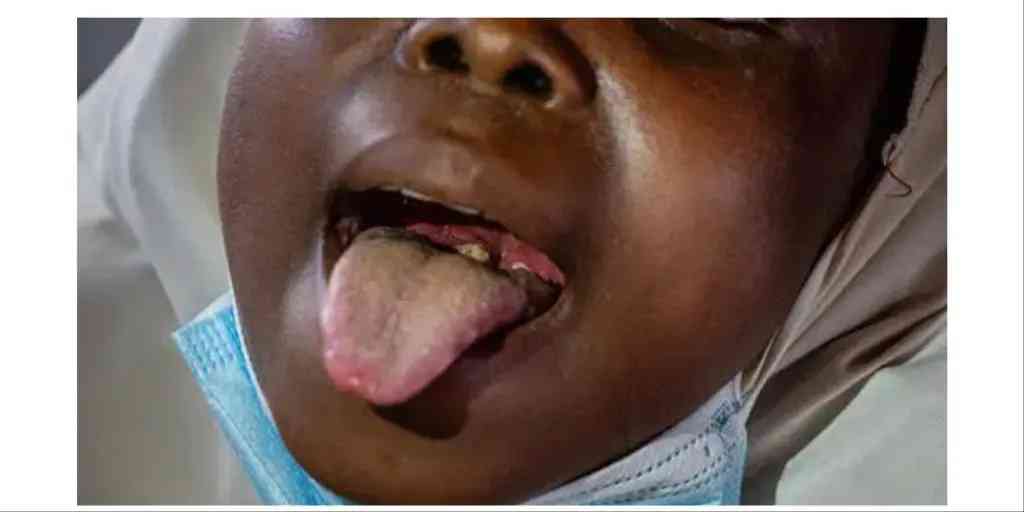 Jigawa State Government has confirmed the death of ten persons due to diphtheria. - MirrorLog