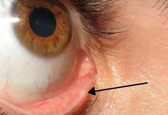 Did you know? The lacrimal punctum is a tiny hole in your eyelids. It drains tears into your nose. That's why your nose runs when you cry. - MirrorLog