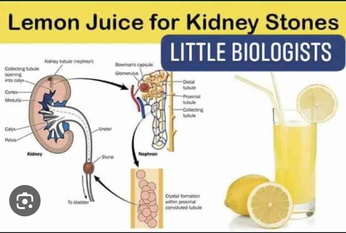 Lemon juice causes kidney stones | MirrorLog