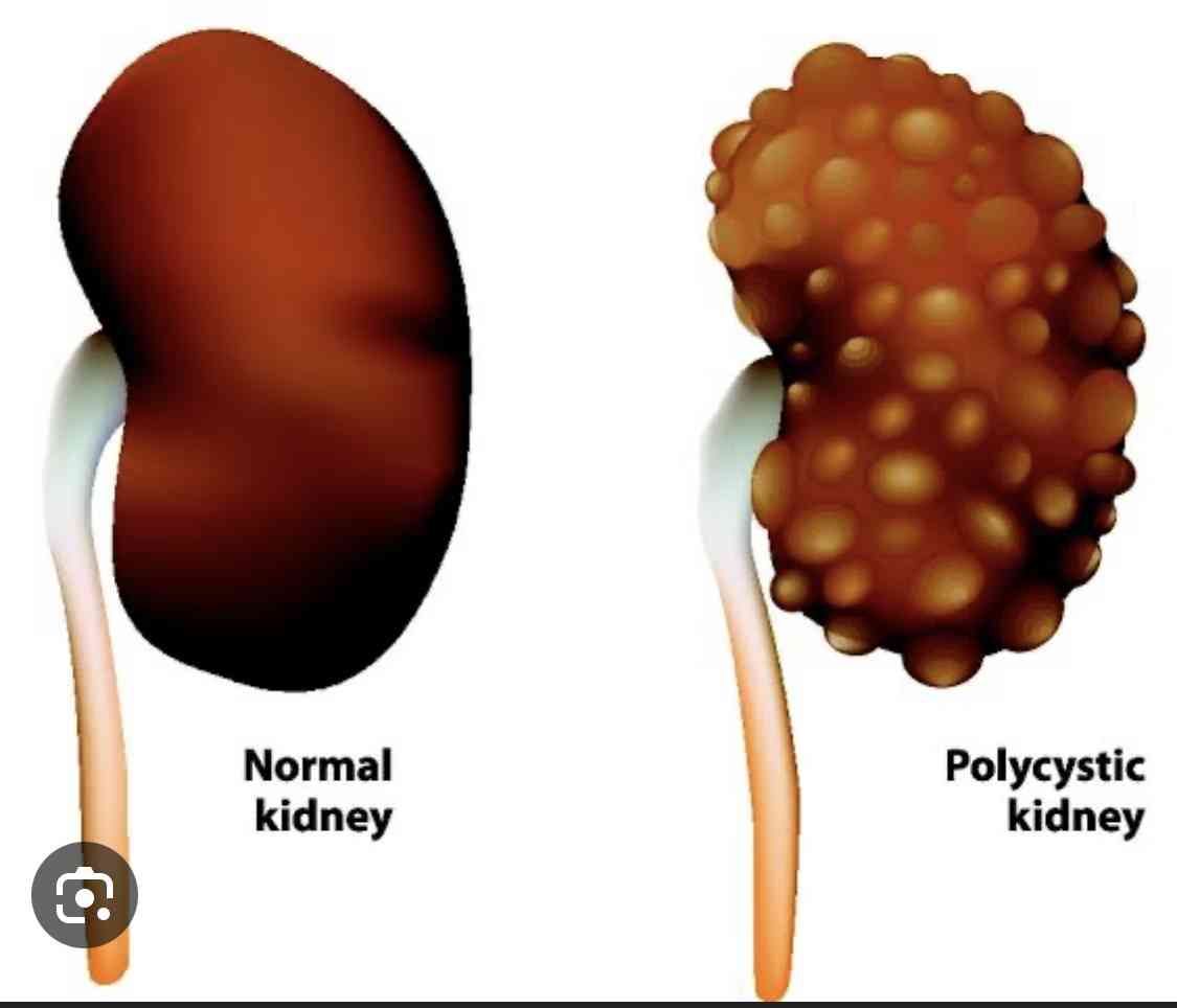 Risk factors of kidney disease - MirrorLog