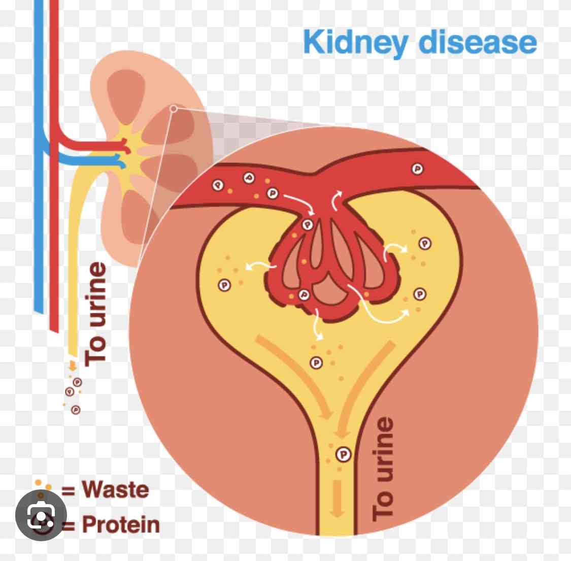 Treatment for chronic kidney disease - MirrorLog