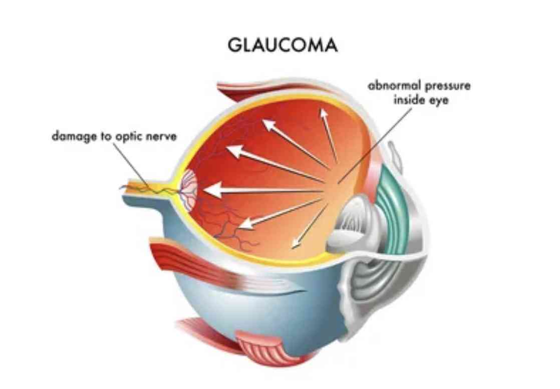 TYPES OF GLAUCOMA - MirrorLog