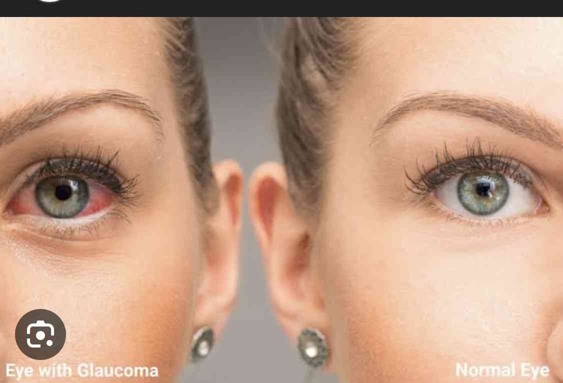 Risk factors of glaucoma - MirrorLog