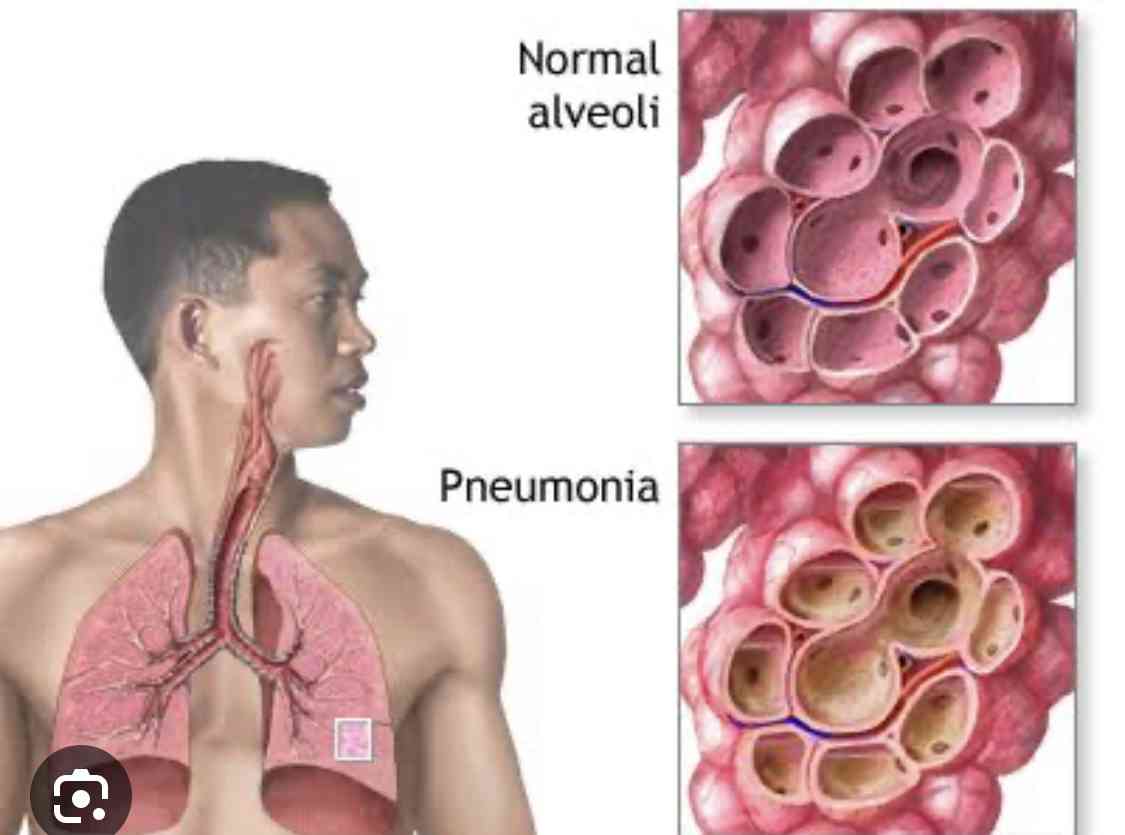 Pneumonia - MirrorLog