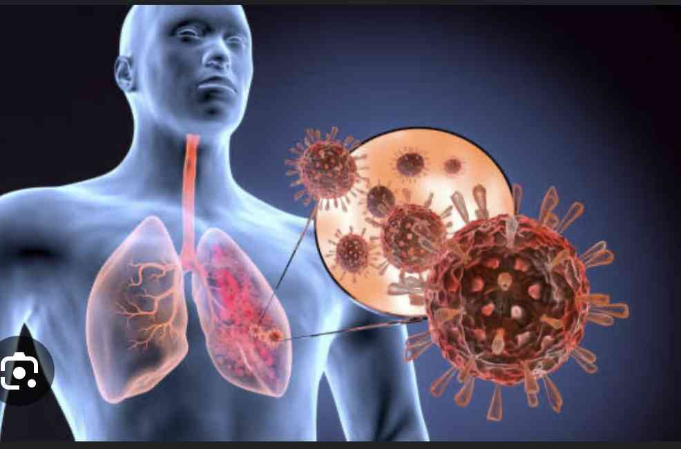 Complications of pneumonia - MirrorLog