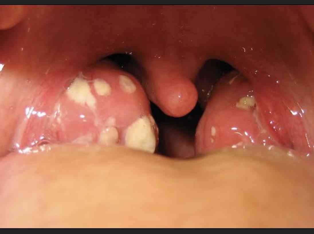 Tonsillitis | MirrorLog