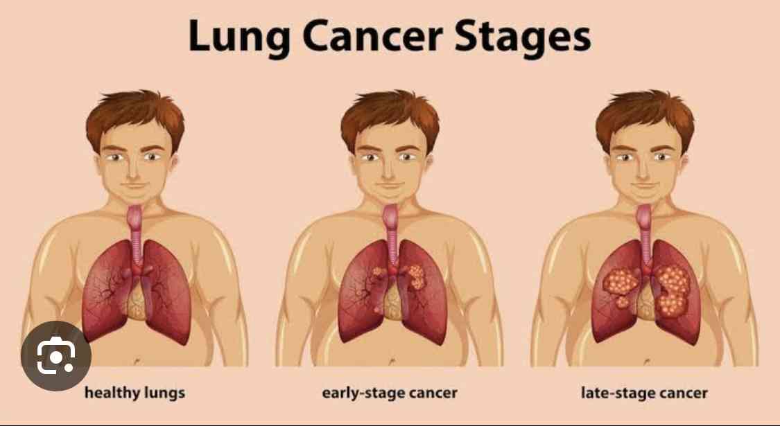 Types of lung cancer | MirrorLog