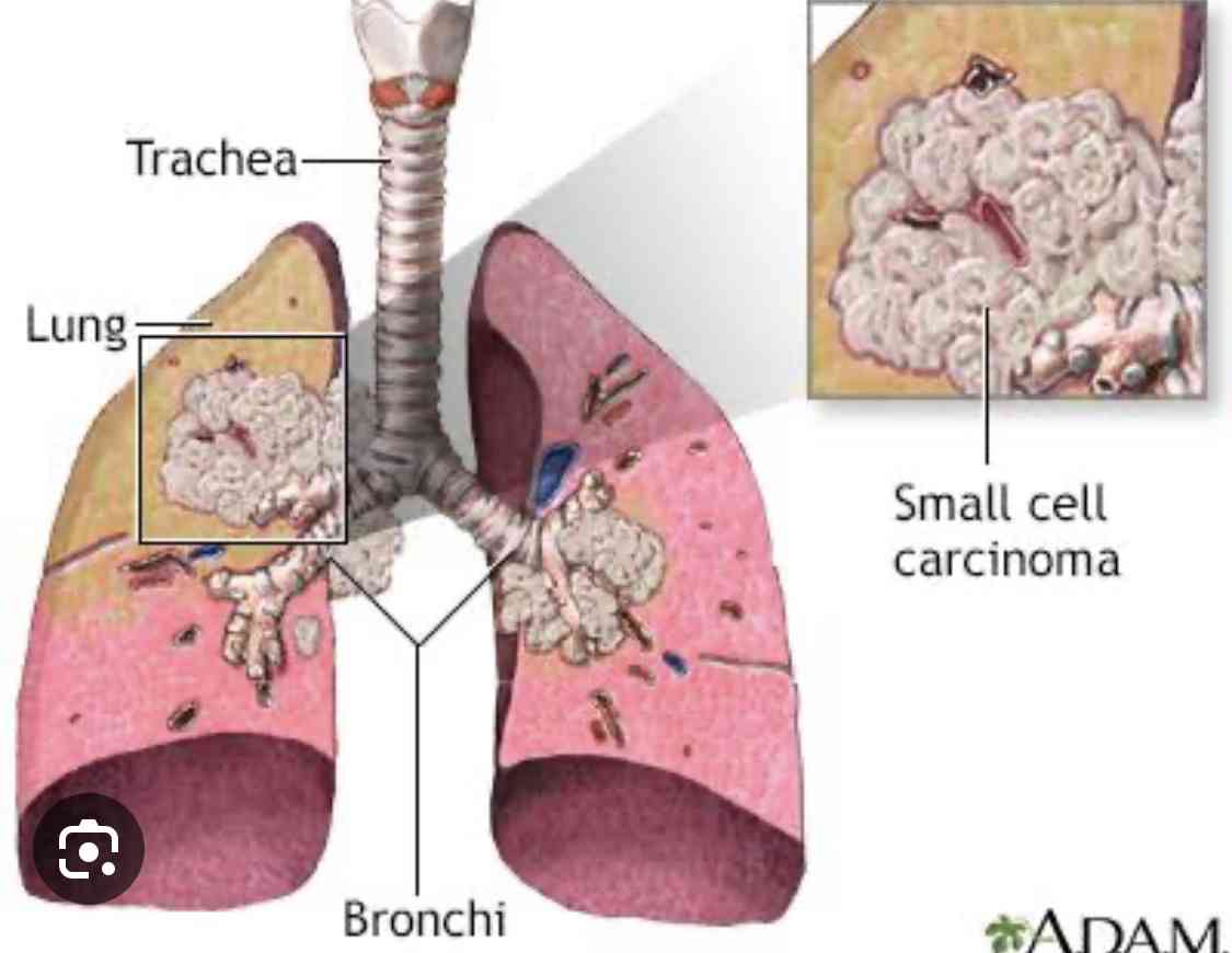 Symptoms of lung cancer - MirrorLog