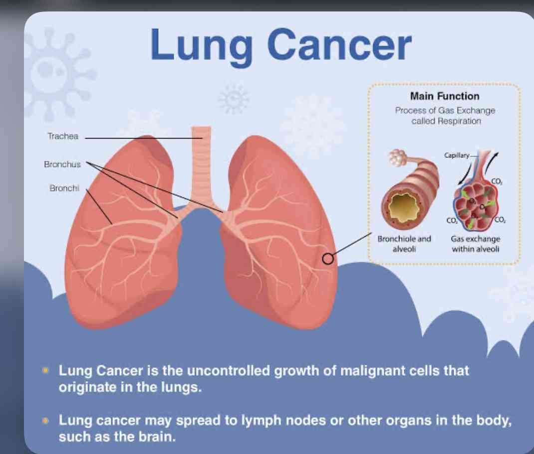 Lung cancer - MirrorLog