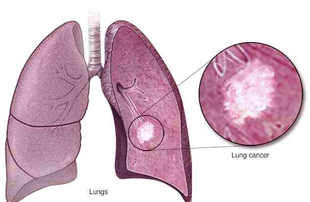 Prevention of lung cancer - MirrorLog