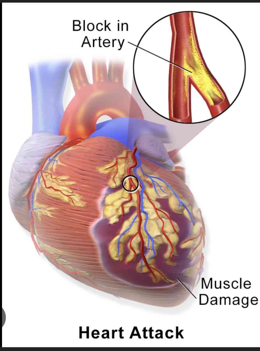 Causes of heart attack. - MirrorLog