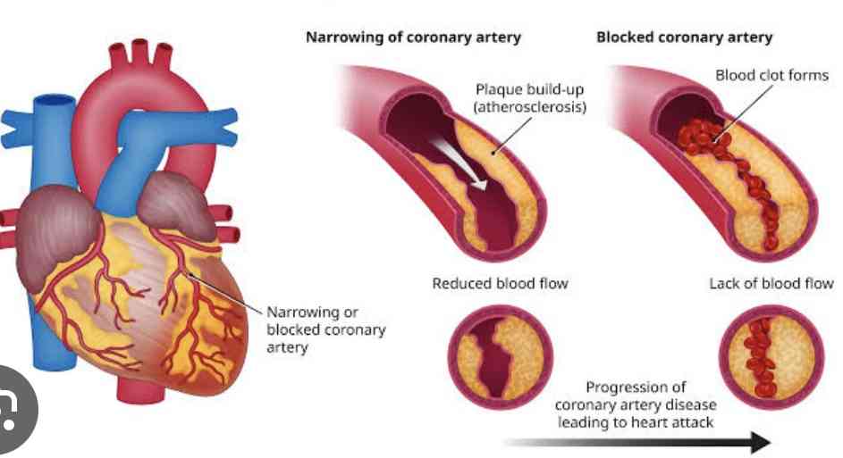 Risk factors of heart attack | MirrorLog