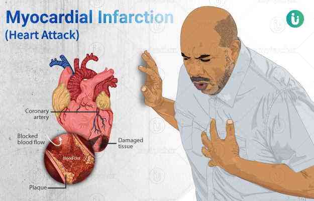 Complications of heart attack - MirrorLog