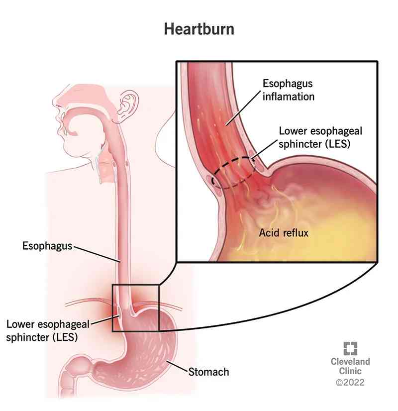 Heartburn - MirrorLog