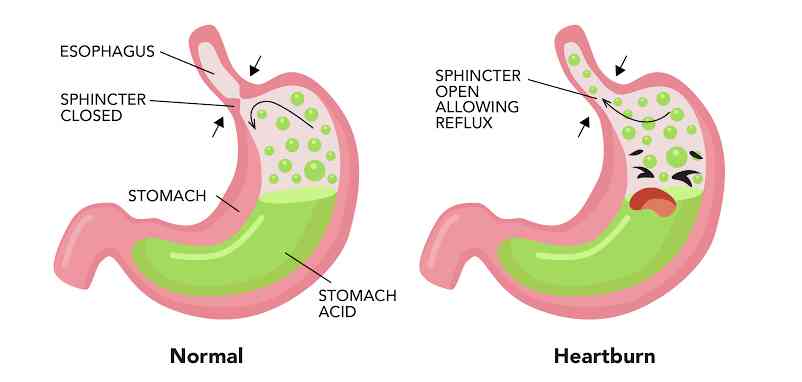 Risk factors of heartburn | MirrorLog