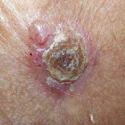 Symptoms of skin cancer - MirrorLog