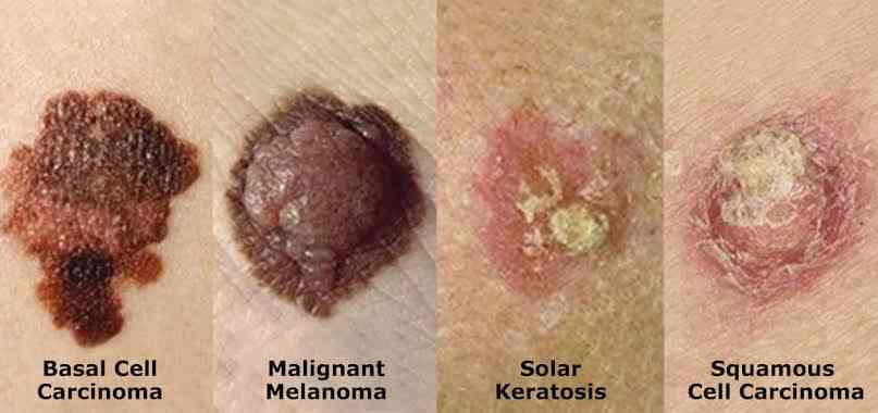 Prevention of skin cancer - MirrorLog