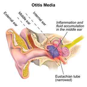 Otitis media | MirrorLog