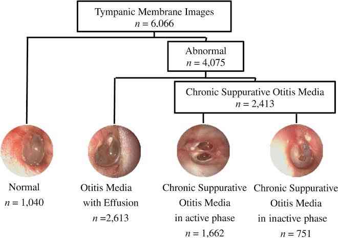 Causes of otitis media - MirrorLog