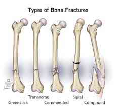 Bone Fracture | MirrorLog