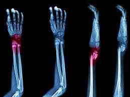 Causes of bone fracture | MirrorLog