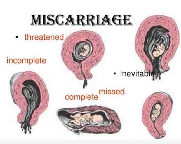 Miscarriage | MirrorLog