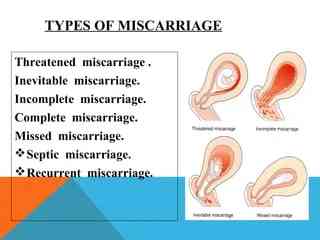 Types of miscarriages | MirrorLog