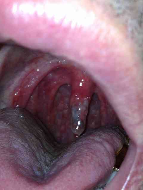 Causes of Uvulitis | MirrorLog