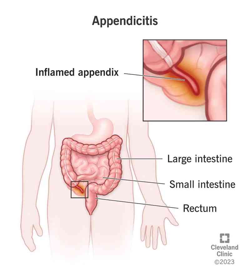 Appendicitis - MirrorLog
