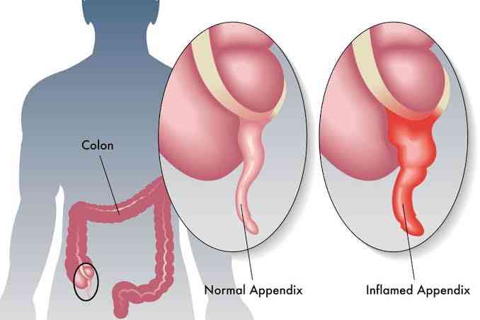 Causes of Appendicitis | MirrorLog