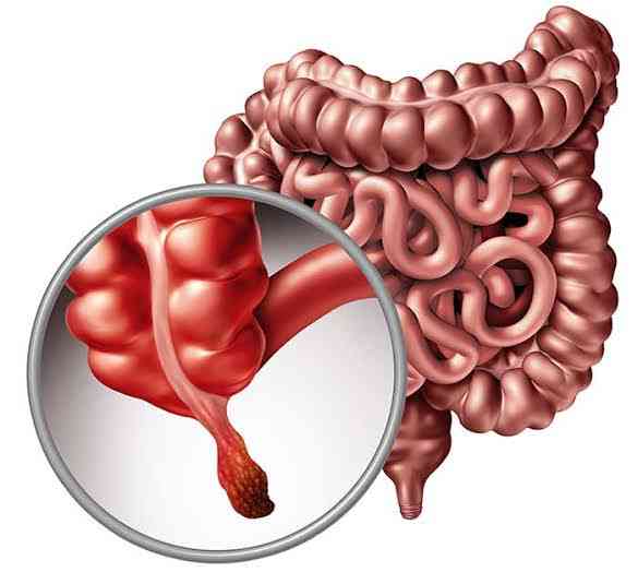 Complications of Appendicitis - MirrorLog