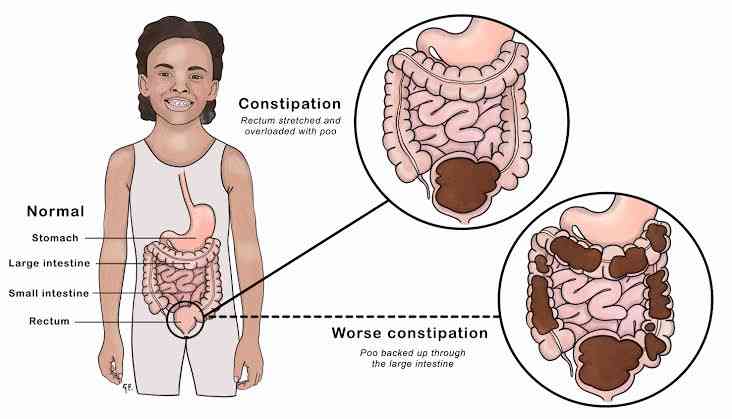 Signs and symptoms of constipation - MirrorLog