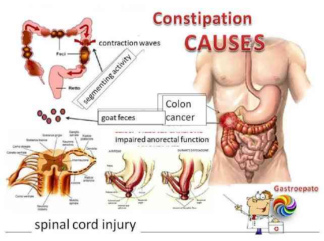 Causes of constipation - MirrorLog