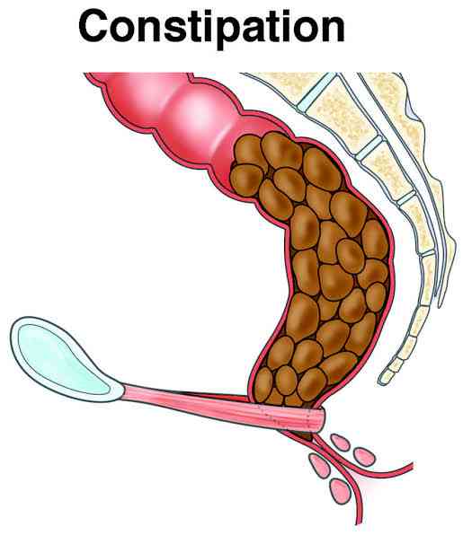 Constipation | MirrorLog