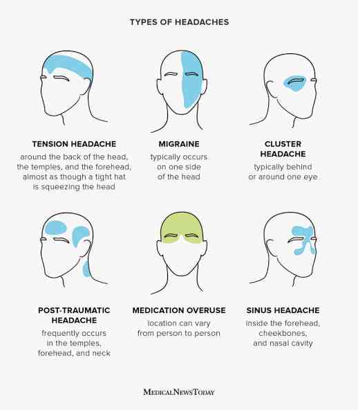 Types of headaches - MirrorLog