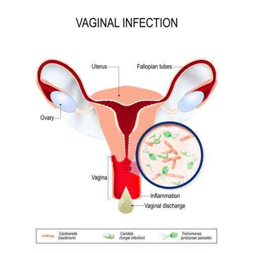 Tips on how to treat vaginal yeast infection - MirrorLog