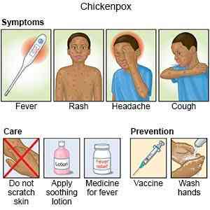 Symptoms of chickenpox - MirrorLog