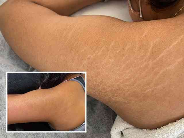 How to get rid of stretch marks - MirrorLog