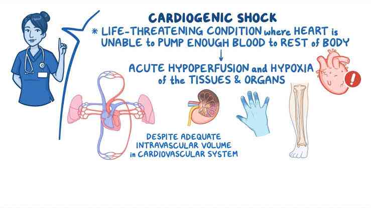 Cardiogenic shock - MirrorLog