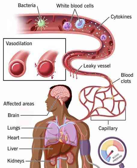 Anaphylactic shock - MirrorLog