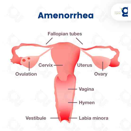 Amenorrhea - MirrorLog