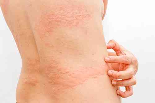 Causes of skin rashes - MirrorLog